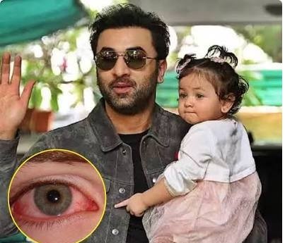 Ranbir ને દીકરી રાહા થકી કન્જક્ટિવાઈટિસનો ચેપ લાગ્યો